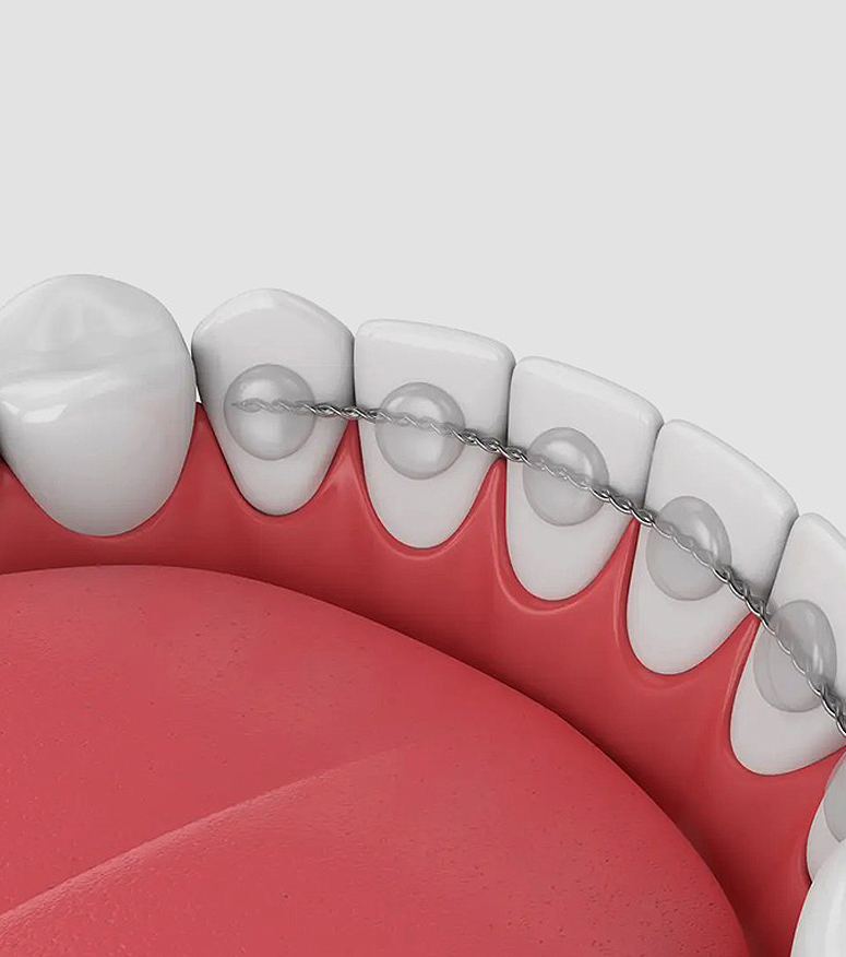 3D dental illustration showing five teeth with progressive gum recession and tooth transparency against pink gum tissue.