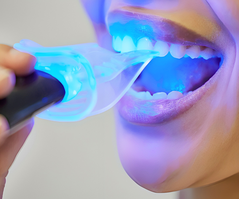 Person using blue LED teeth whitening device on lower teeth against neutral background.