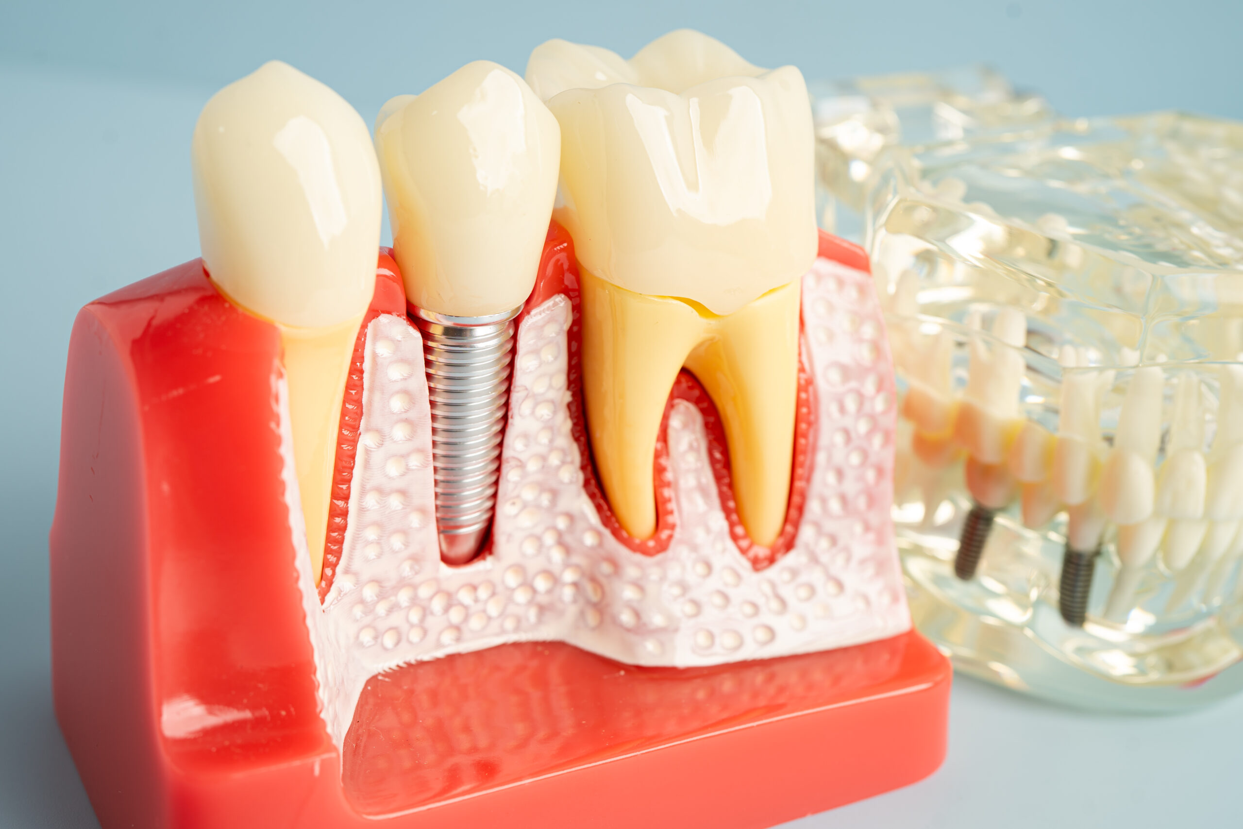 3D model showing a dental implant placed in the jawbone with a crown attached next to a natural tooth