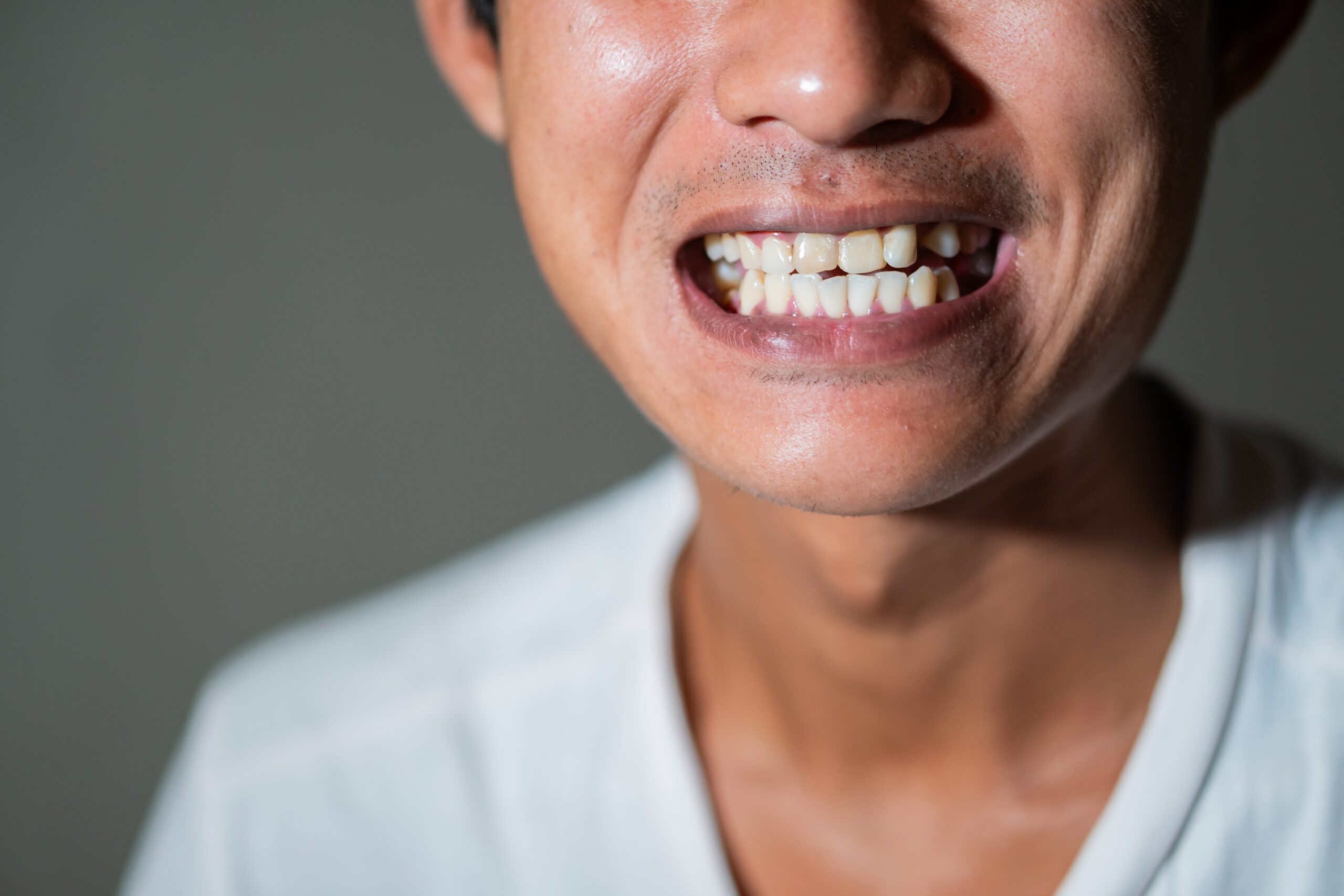 Close-up of adult smiling with slightly uneven front teeth showing a misshapen tooth concern