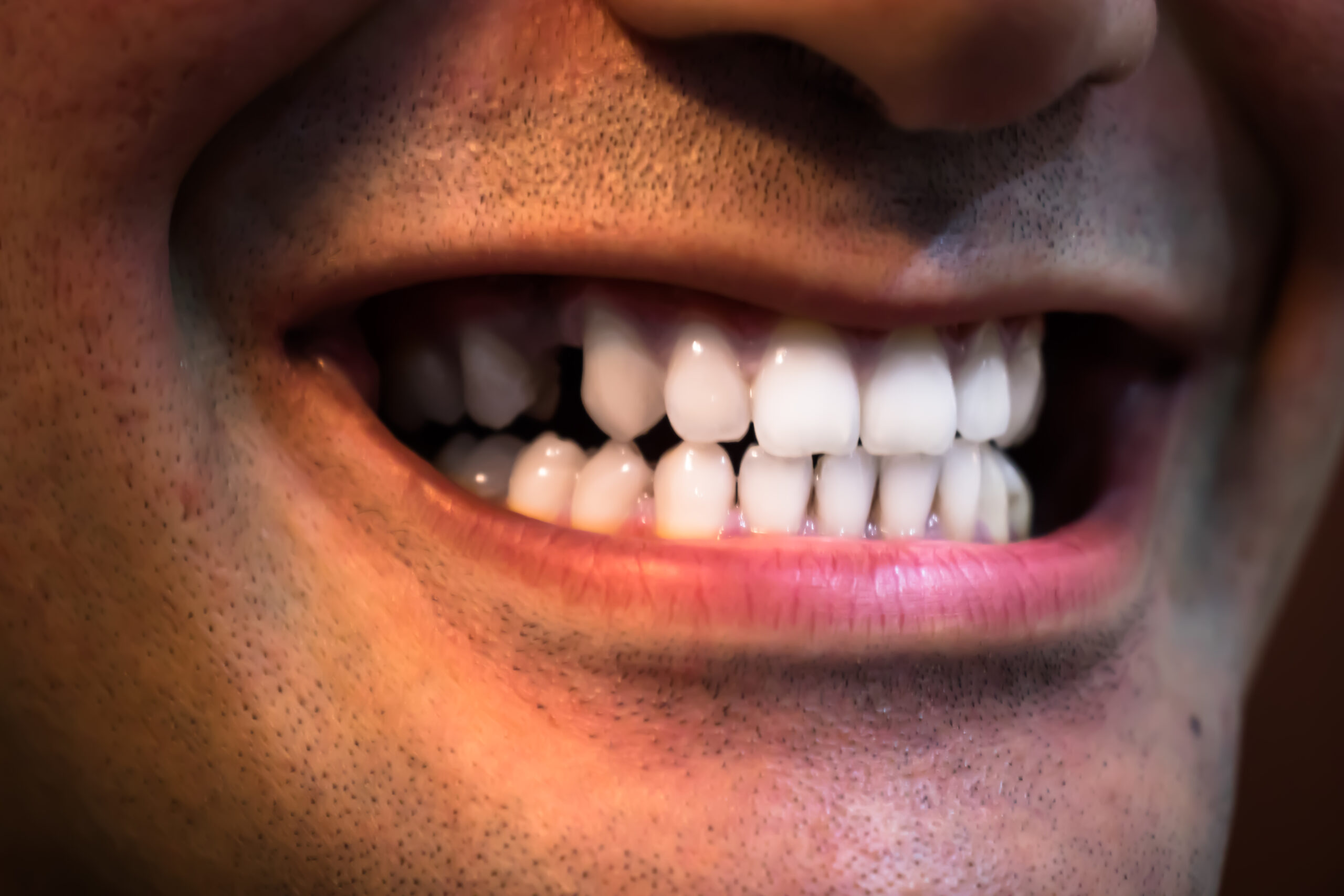 Close-up smile showing a missing tooth gap that may affect surrounding teeth over time