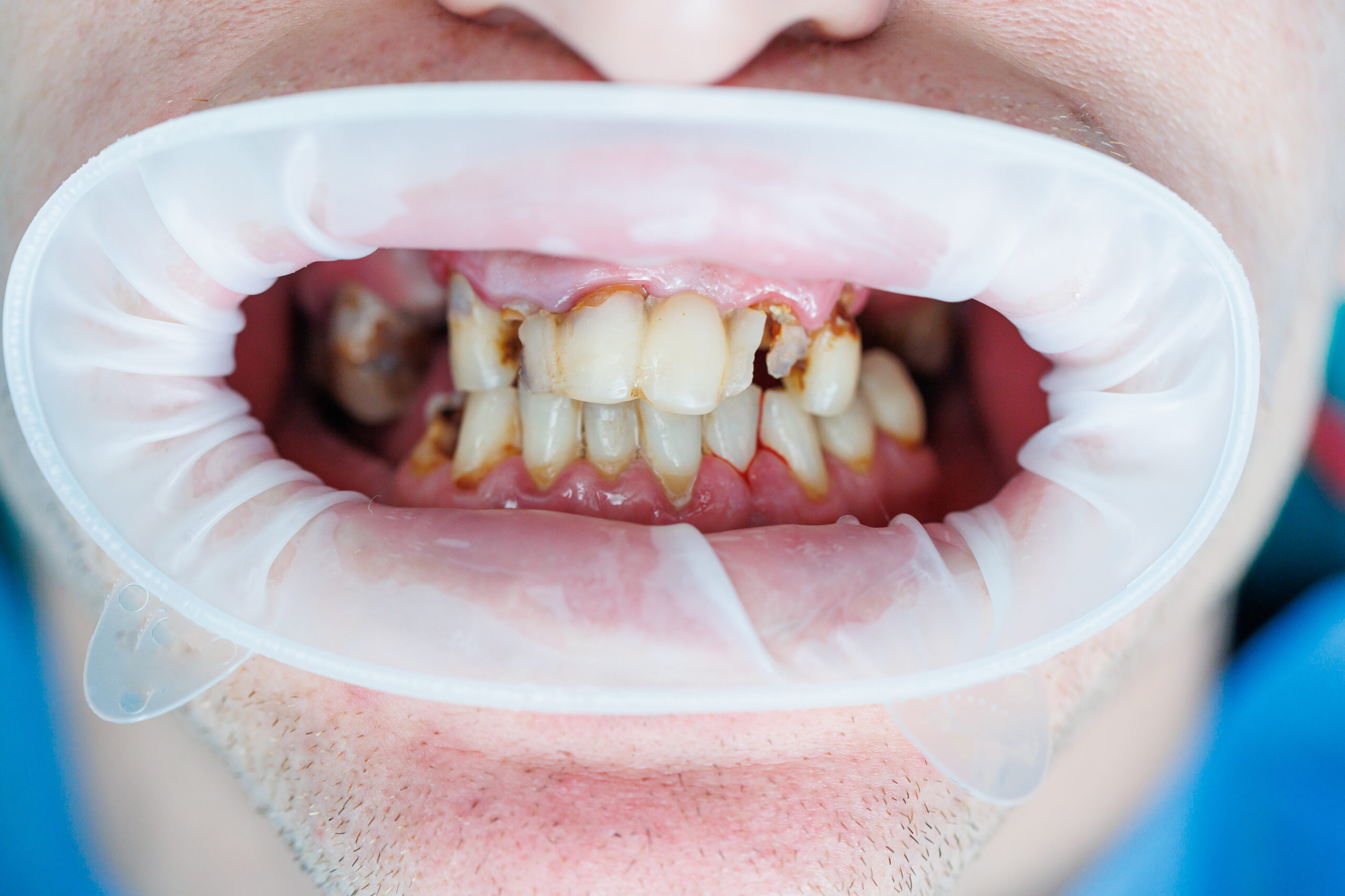 close-up of severely damaged teeth with decay and fractures during a dental examination