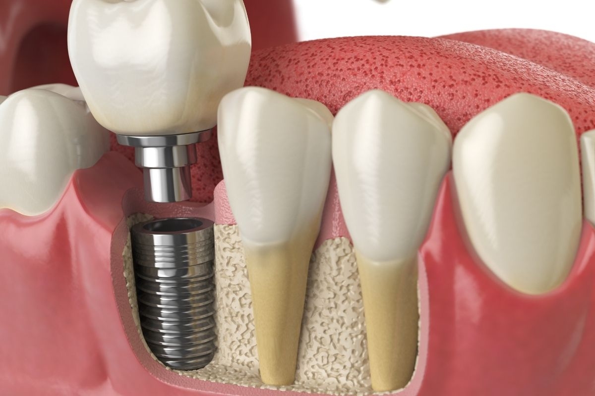 Dental implant replacing a missing tooth in the jaw